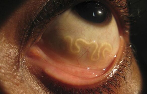 El gusano Loa Loa vive en el ojo humano y causa ceguera